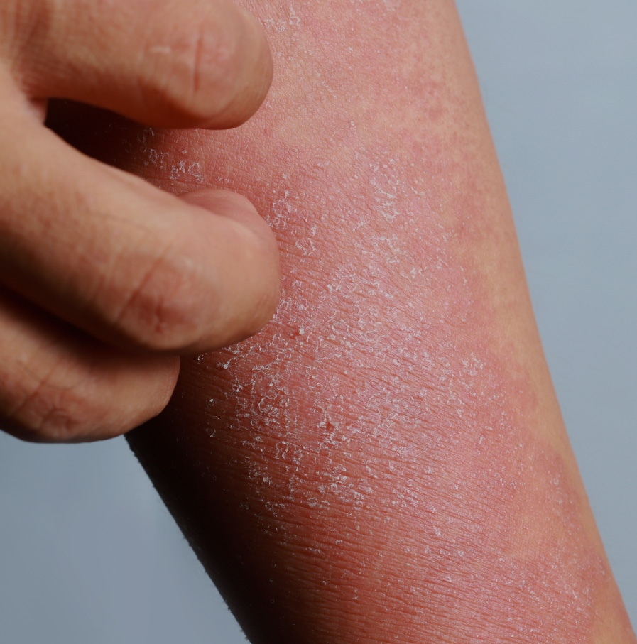 Skin condition: atopic dermatitis