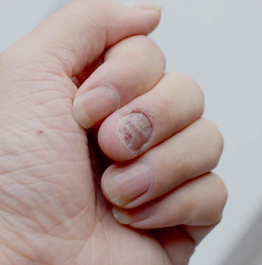 Skin condition: cracked nails