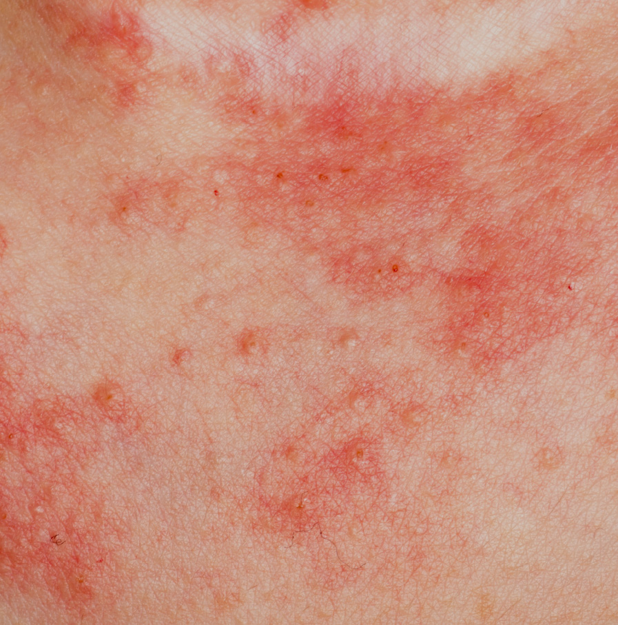 Eczema ~ skin condition